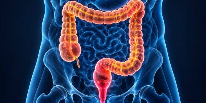 Colorectal cancer medical illustration showing the colon, rectum and tumor location